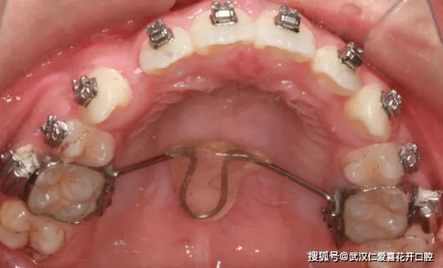 牙突,牙突出怎么矫正