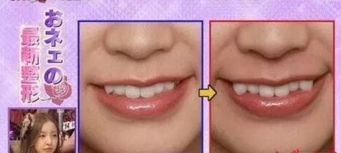 八重齿是什么牙齿