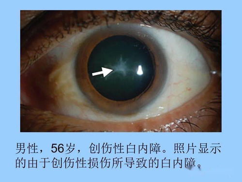 眼球,眼球发红充血怎么回事