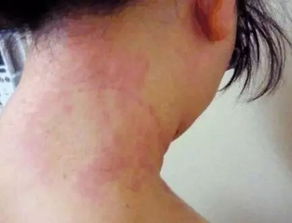 对水过敏怎么办?