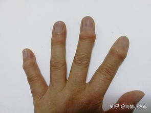 右手食指成这样是稍微变形还是严重变形?