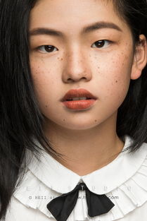 少女脸上长雀斑怎么治