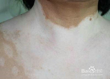 有白块怎么办，身上皮肤有白块怎么办